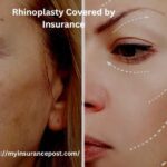 How to Get Rhinoplasty Covered by Insurance