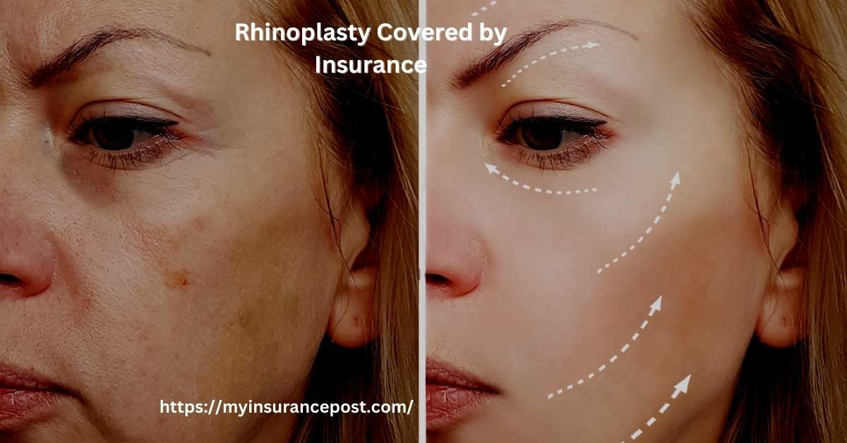 How To Get Rhinoplasty Covered By Insurance 2024