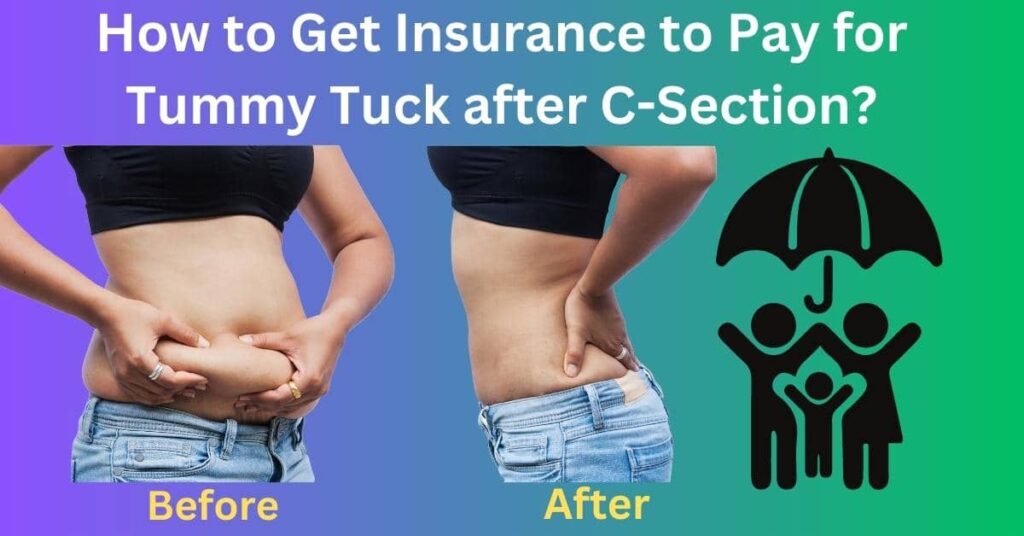 How to Get Insurance to Pay for Tummy Tuck after C-Section