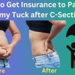 How to Get Insurance to Pay for Tummy Tuck after C-Section